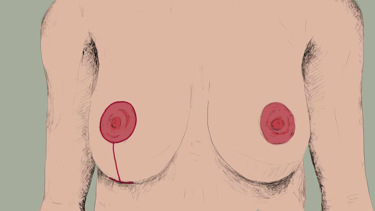 Brustverkleinerung Narbe