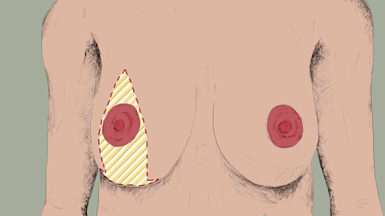 Brustverkleinerung neue Schnittführung