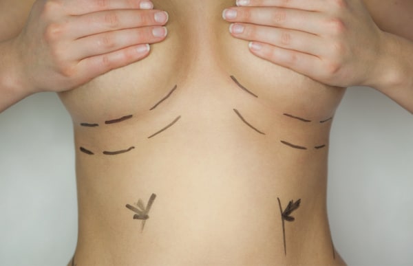 Schnitte angezeichnet für Brustrekonstruktion © detailblick - Fotolia.com